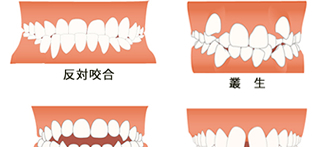 第4回 ３歳児検診で歯並びに不正