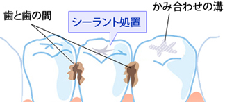 第16回 虫歯予防のシーラント処置