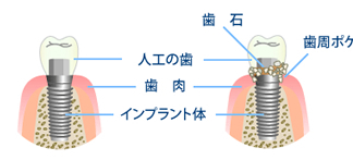 第25回 インプラント後の手入れ