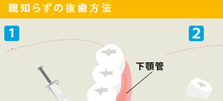 第37回 親知らずの抜歯